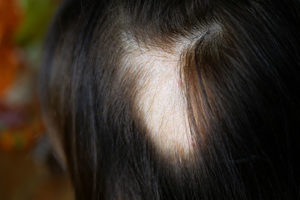 Hair Loss / Alopecia Treatments Near Me Arlington, VA | DC, McLean