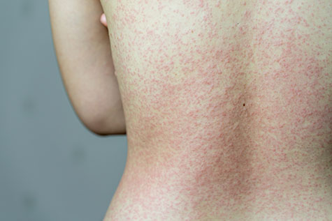 hives rash