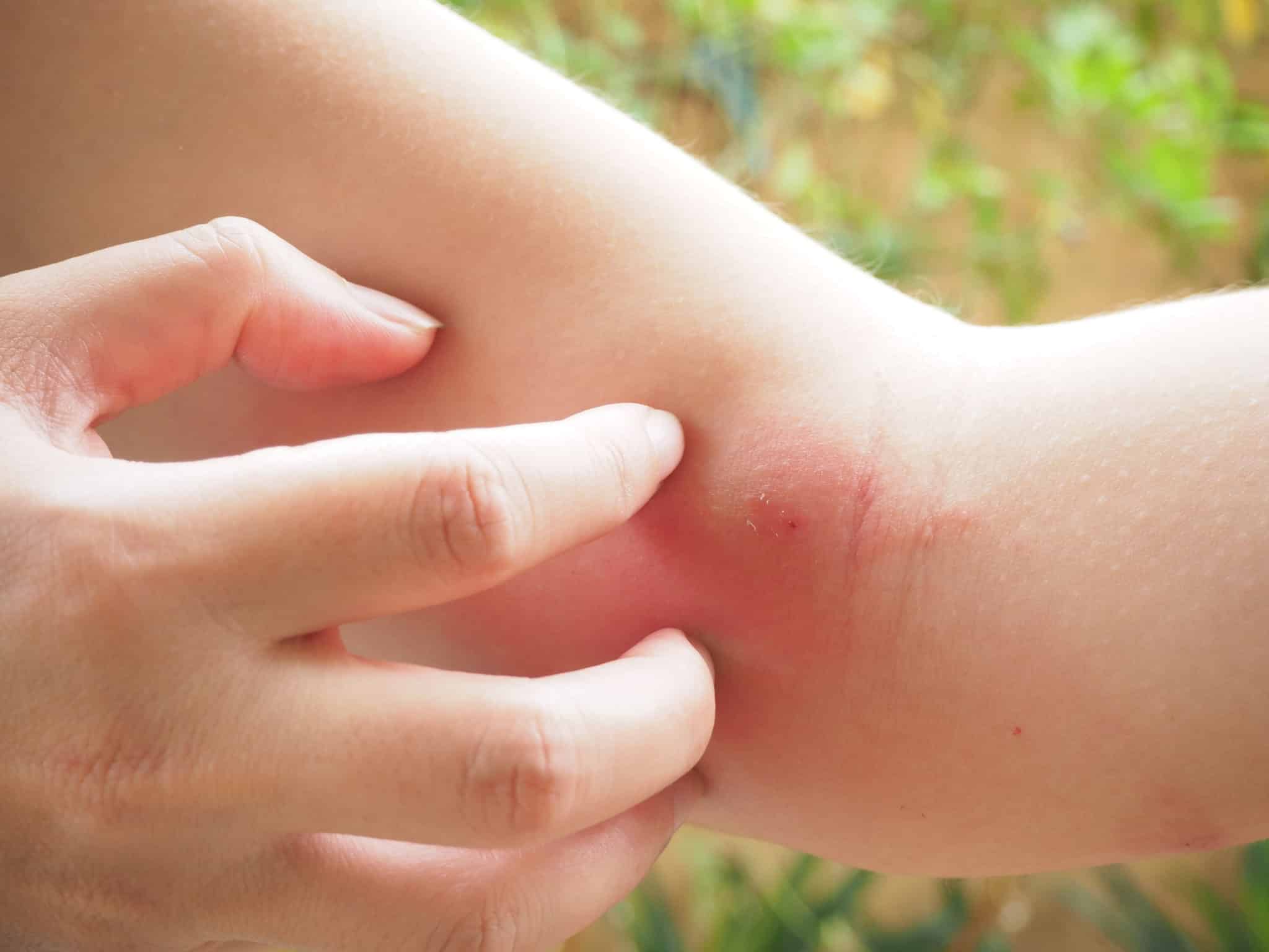 Common Bug Bites & What To Do About Them - Arlington Dermatology