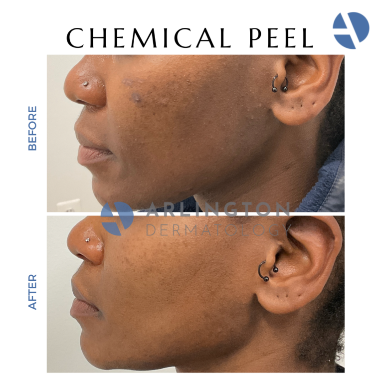 Chemical Peels Near Me Arlington Va Dc Mclean Alexandria